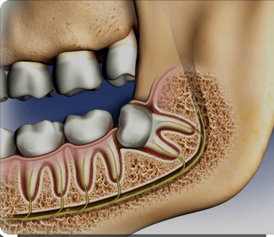 Image for Wisdom Tooth Extraction