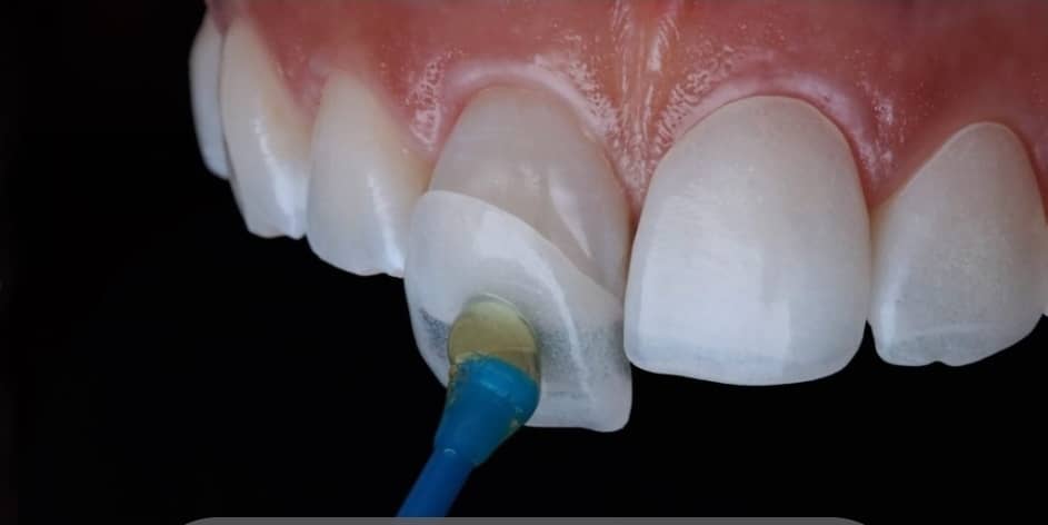 Image for Dental Veneer