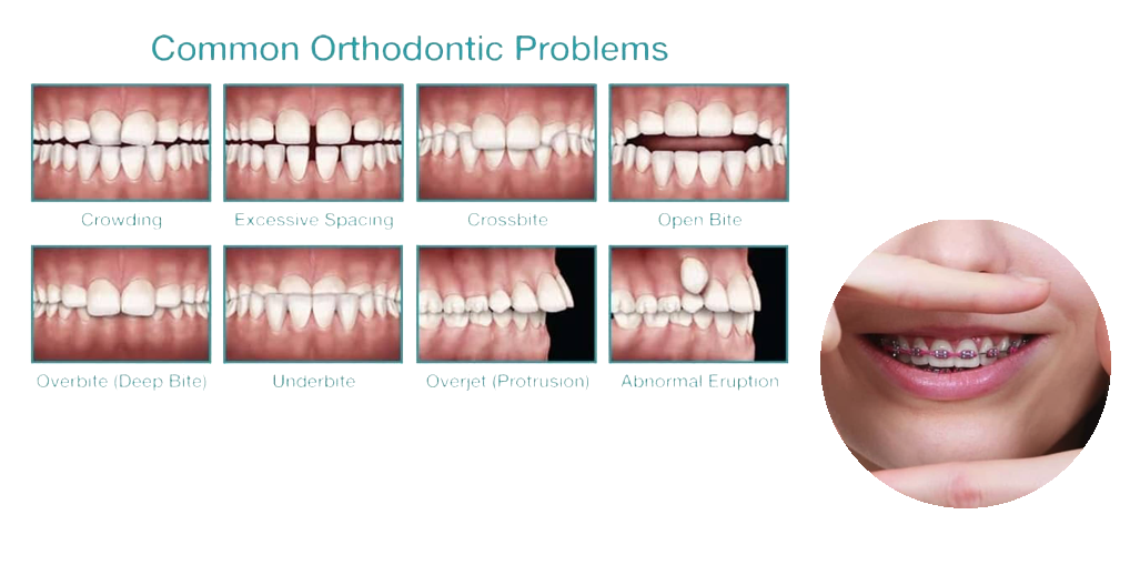 Image for Dental Braces