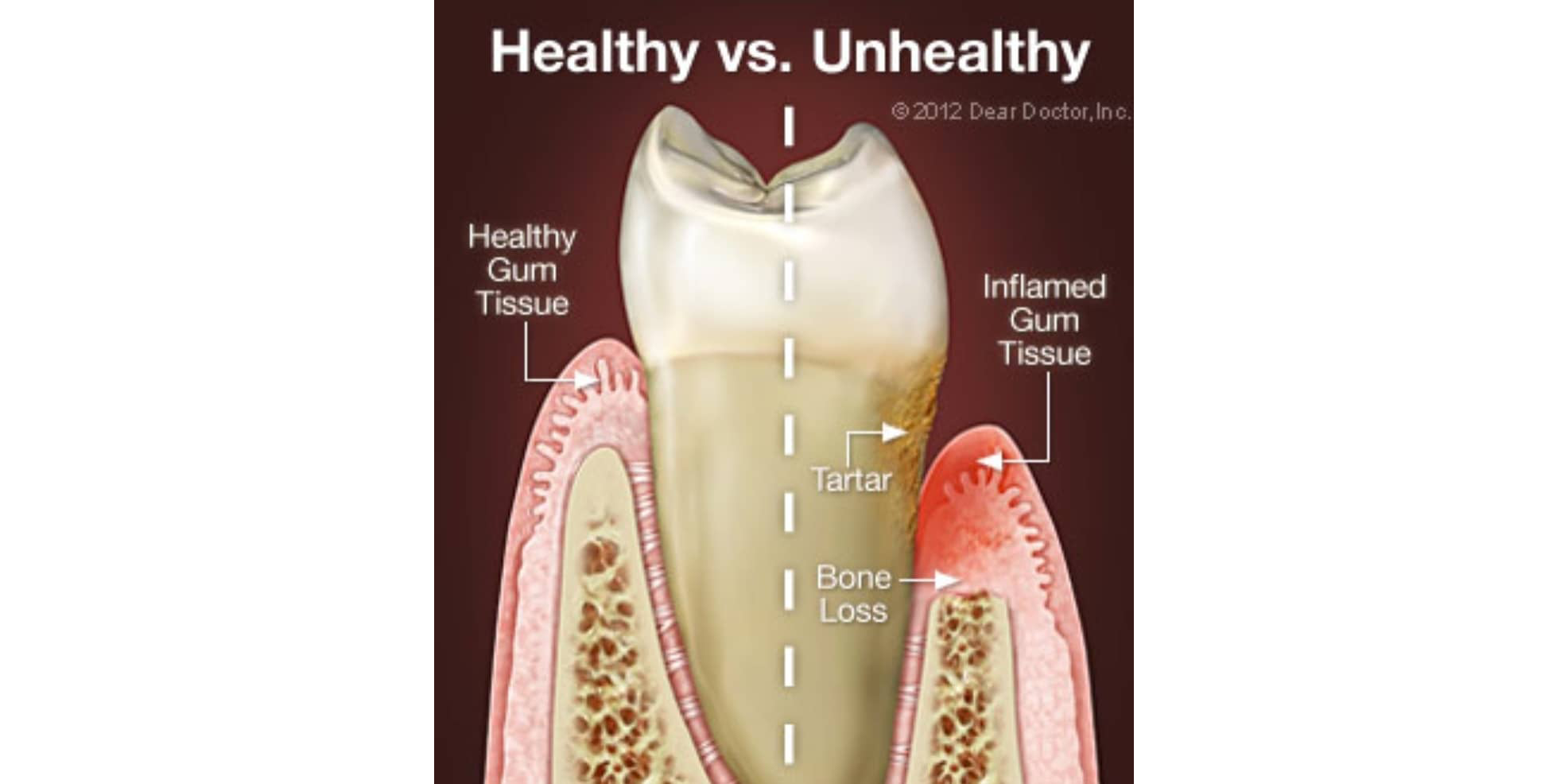 Image for Gum Disease Treatment