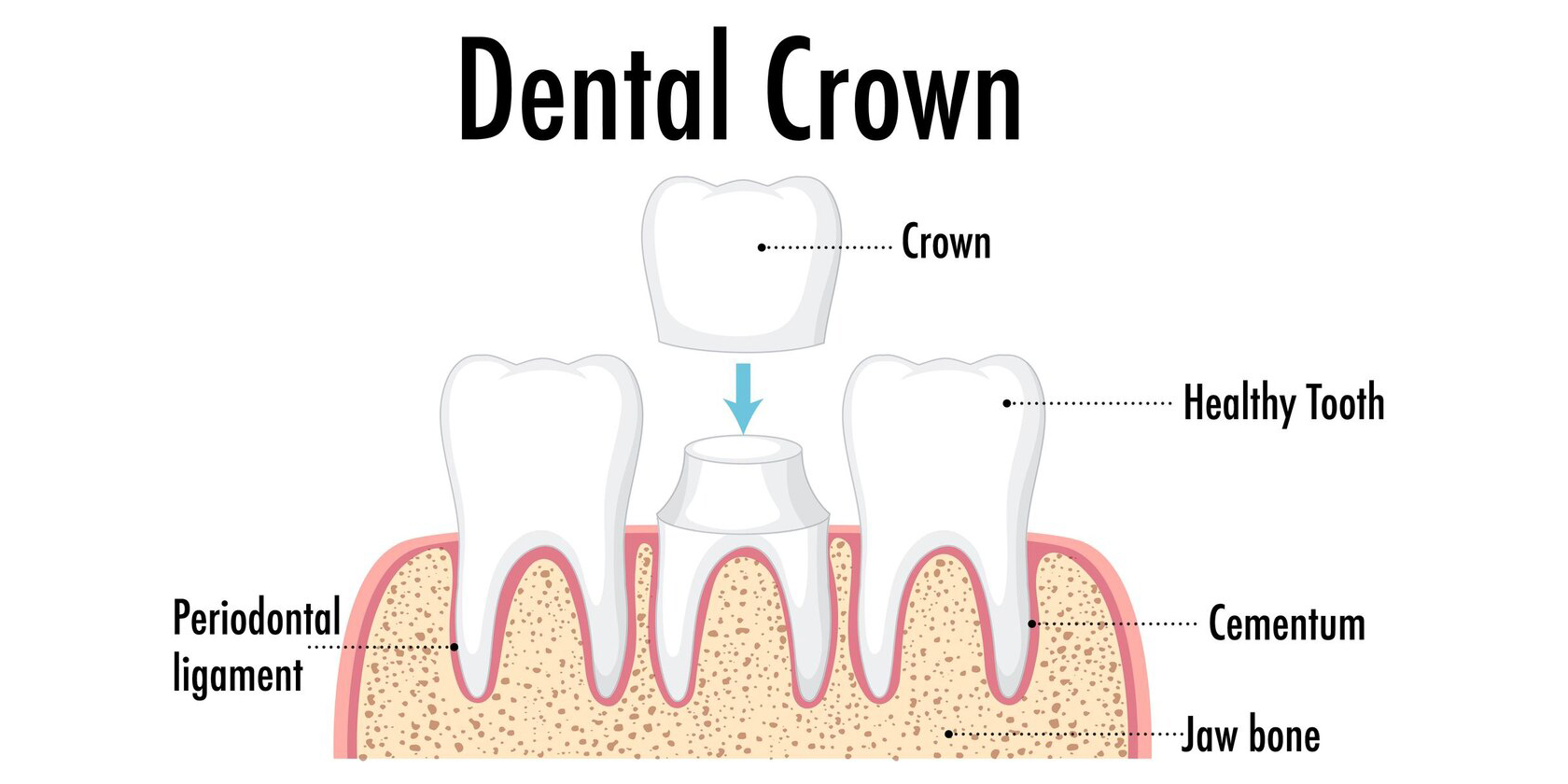 Image for Crown & Bridge